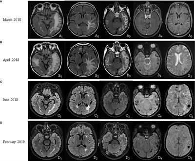 Case Report: Probable Cerebral Amyloid Angiopathy-Related Inflammation During Bevacizumab Treatment for Metastatic Cervical Cancer